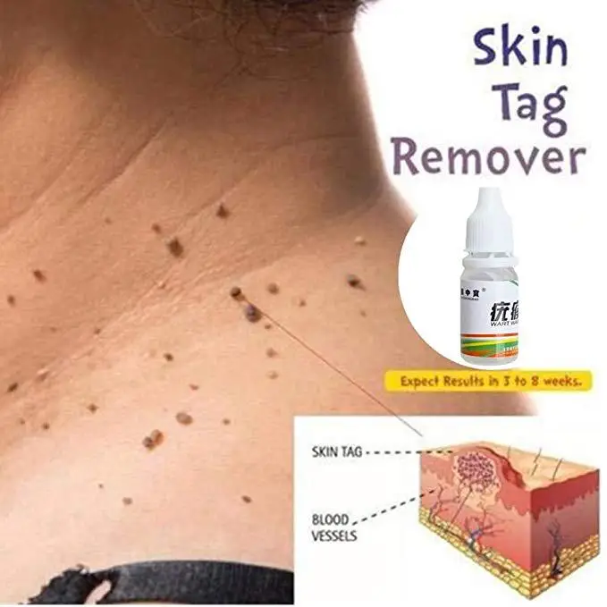 

Foot Care Tools Skin Tag Remover Body Warts Treatment Foot Corn Removal Plantar Warts Ointment Foot Care Medical Plaster