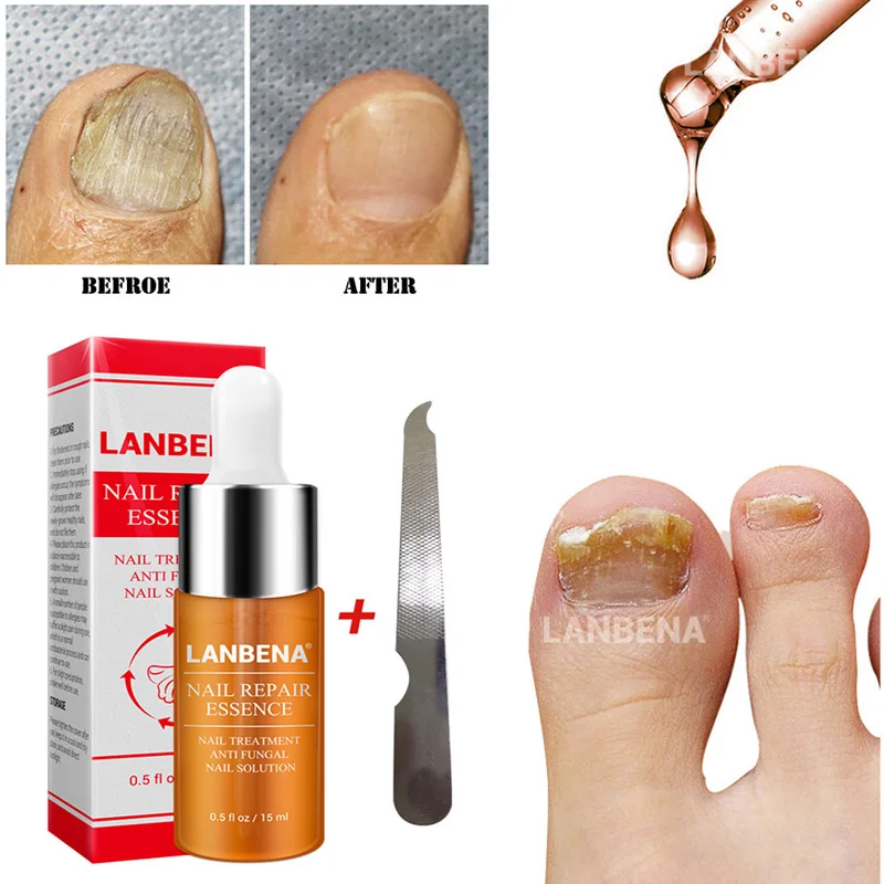 

LANBENA Nail Fungus Treatment Onychomycosis Removal Nails Care Repair Liquid Hands and Feet Care of Toe Nail Nourishing Brighte