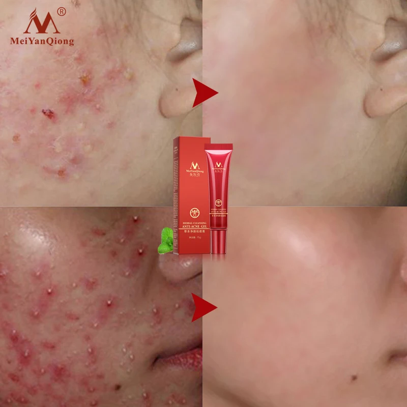 

High Quality Herbal Cleansing Face Anti-acne Treatment Cream Herbal Scar Removal Oily Skin Acne Spots Face Skin Care