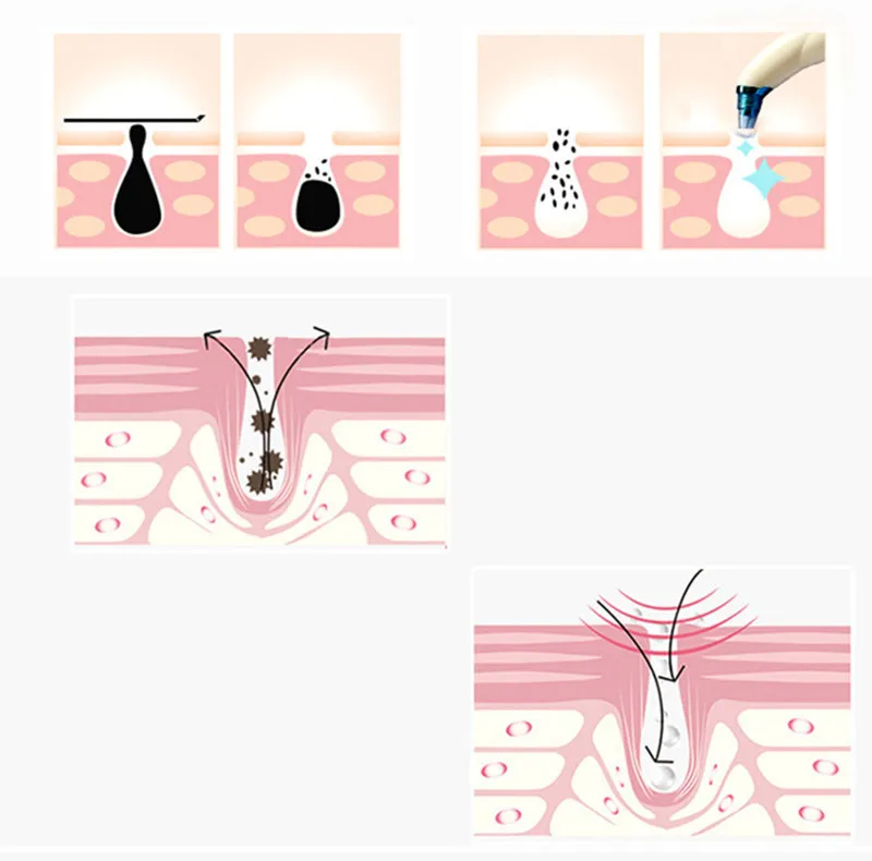 Вакуумный прибор для удаления угрей, электрический прибор для очистки пор в носу, очиститель для удаления угрей, инструмент для красоты, дропшиппинг