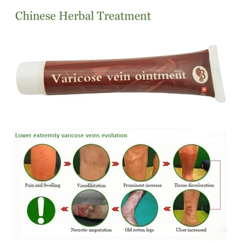 

Varicose Veins Treatment Cream Effective cure Vasculitis Phlebitis Spider Veins Pain Varicosity Angiitis ointment Health Care