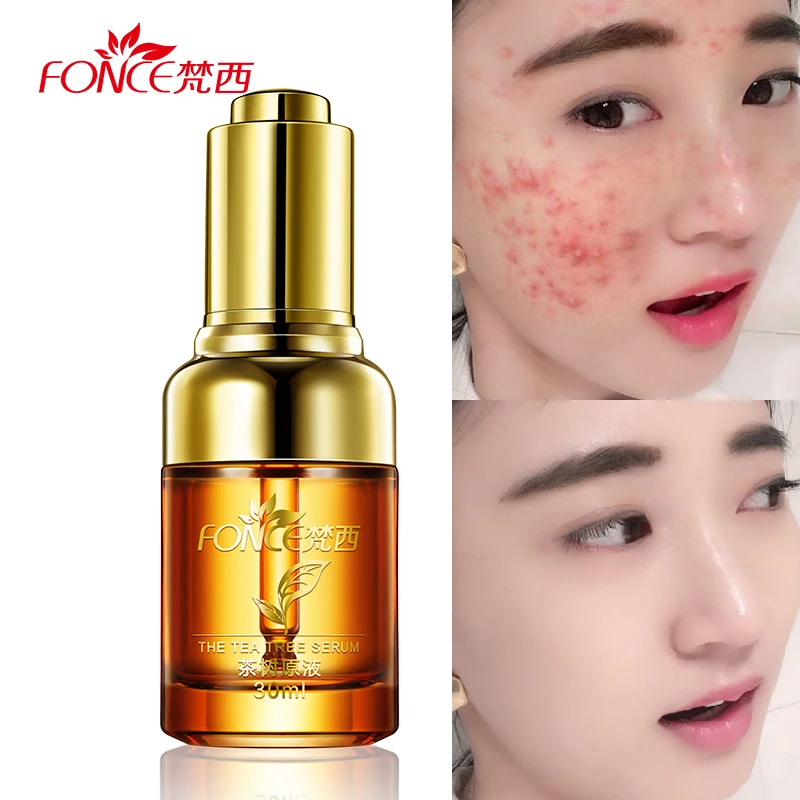 Fonce Face Acne Treatment Liquid 30ml Tea Tree Serum Natural Plant Essence Skin Care Pigmentation Corrector Shrink Pores Serum pitt исследование филиппинского belif торф живой жизнеспособность essence 30ml
