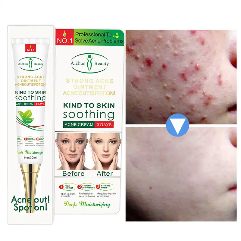 14 Beautiful Aichun beauty anti acne cream reviews Haircut 2021