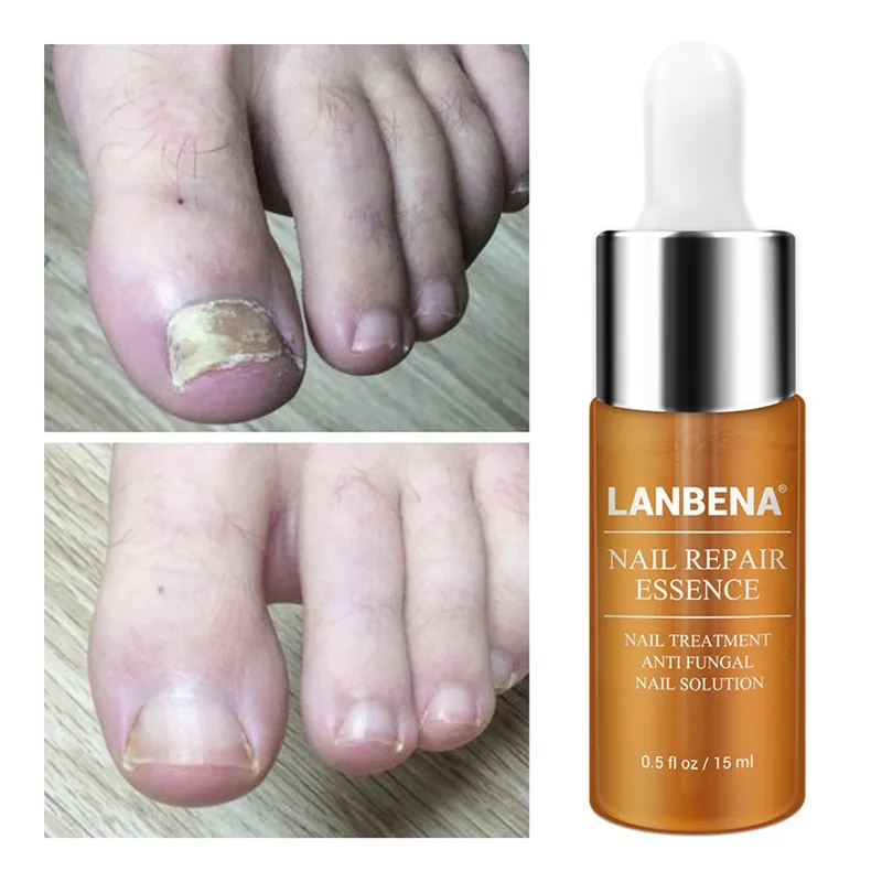 Foot Nail Care Treatment Bright Fungal Nail Repair Onychomycosis Removal Essence Foot Care Anti Infection