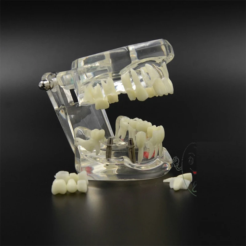 Новая Стоматологическая модель зубов имплантата исследования анализа демонстрационных заболеваний восстановления