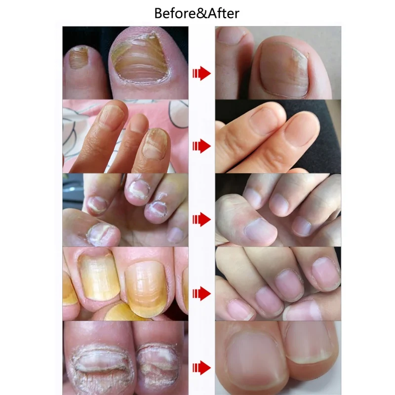 30 мл онихомикоз грибковая обработка Лечение ногтей Удаление гель Уход эссенция масло для ногтей отбеливающий носок грибок для ногтей