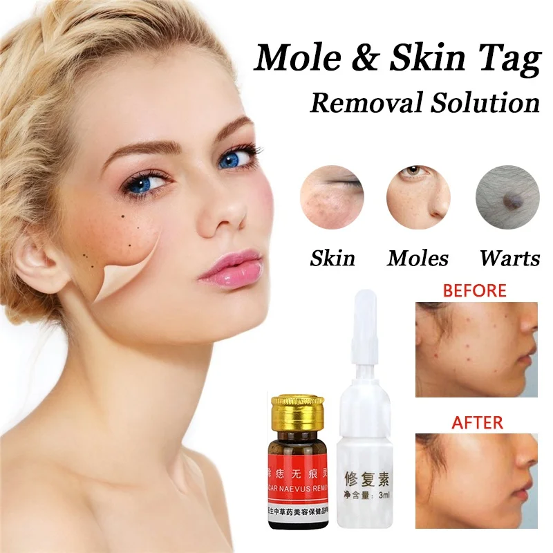 

Painless Mole Skin Dark Spot Removal Face Wart Tag Freckle Removal Cream Oil Mole Skin Tag Removal Solution