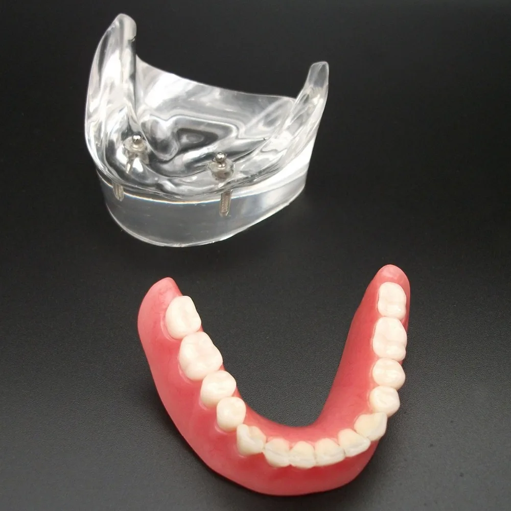 Стоматологическая Overdenture уступает с 2 имплантатами Demo модель исследования модель