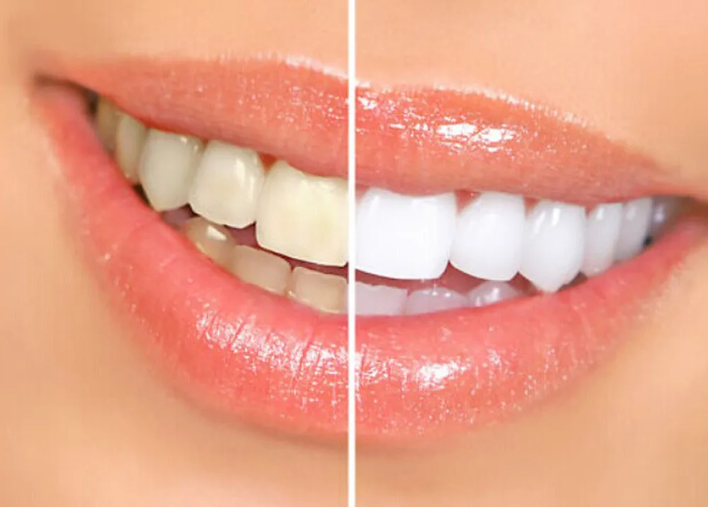 Hot Teeth Whitening Stain Removal Whitening Toothpaste Fight Bleeding Gums Toothpaste Blanqueamiento dental F7.18