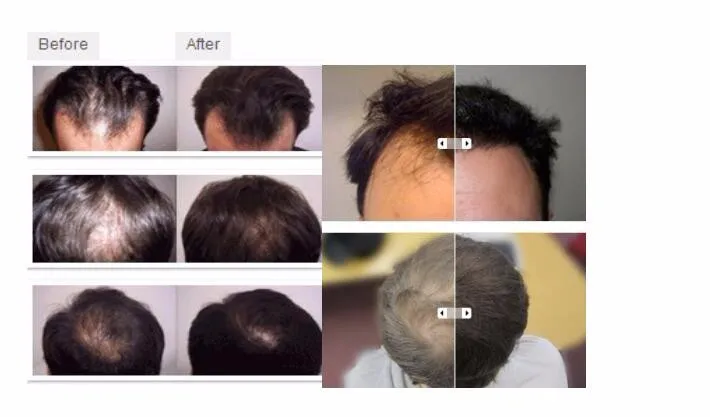 High Quality hair loss