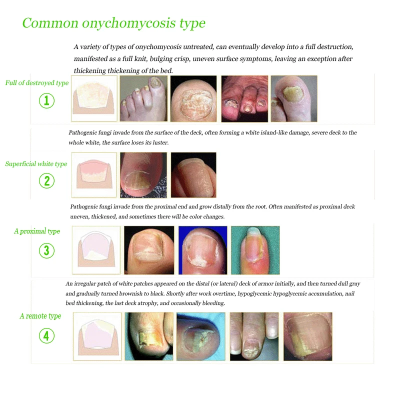 5 шт. китайское травяное Лечение ногтей от грибка противогрибковые инфекция ногтей онихомикоз гриб для ногтей paronychia лучше, чем эссенция