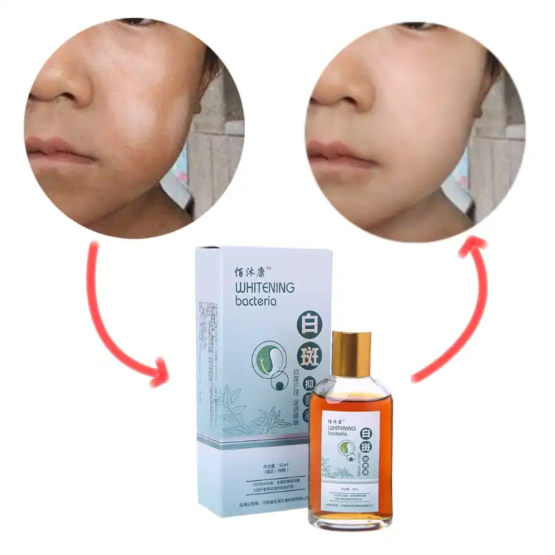 50ml Skin Liquid Repair Melanin White Spot Vitiligo Treatment