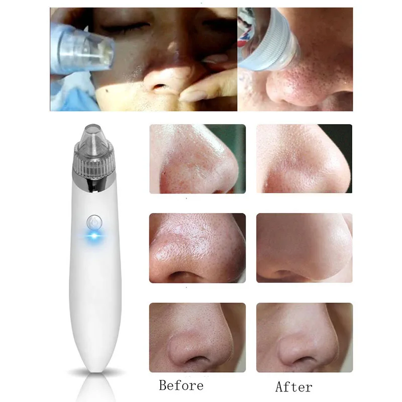 Электрический инструмент для удаления акне точка Noir Blackhead вакуумный экстрактор