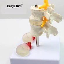 Lumbar Lesion Model Human Fourth and Fifth Lumbar Vertebrae Lumbar Lesion Model Medical Teaching Model Lumbar Lesion Model Human Fourth and Fifth Lumbar Vertebrae Lumbar Lesion Model Medical Teaching Model
