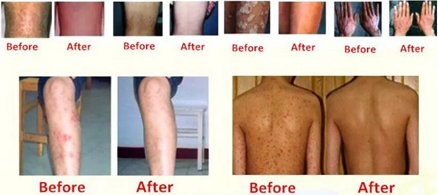Herb-Anti-Psoriasis-Treatment-Eczema-Psoriasis-Vitiligo-Psoriasis-Cream-Anti-Fungal-Antipruritic-Skin-Itching-Cream-Skin (3)