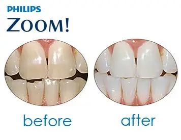 Philips Zoom Daywhite One Syringe Teething Gel Acp Teeth Whitening Kit Day Whiten Teeth In Replacement Toothbrush Heads From Home Philips Zoom Daywhite One Syringe Teething Gel Acp Teeth Whitening Kit Day Whiten Teeth In Replacement Toothbrush Heads From Home