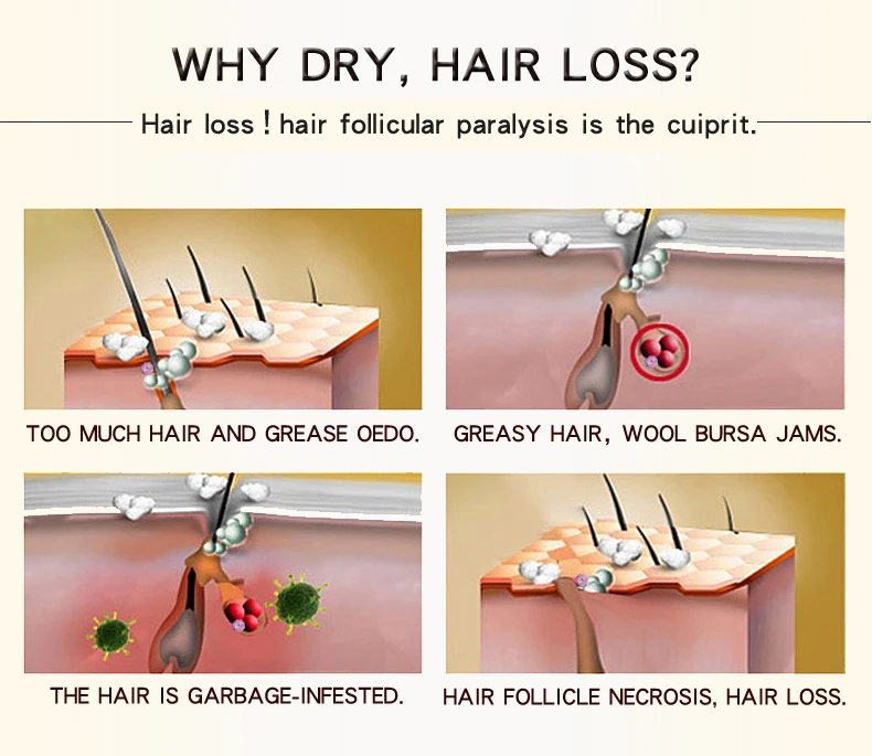 30 мл марокканское масло для волос Лечение выпадения женьшеня имбирное масло для роста волос травяное для сухих волос уход за волосами типы кожи головы травяное лечение эссенция
