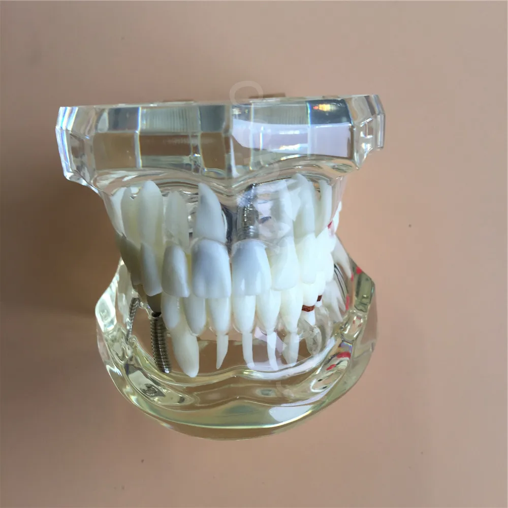 

Dental Implant Disease Teeth Model With Restoration Bridge Tooth Dentist