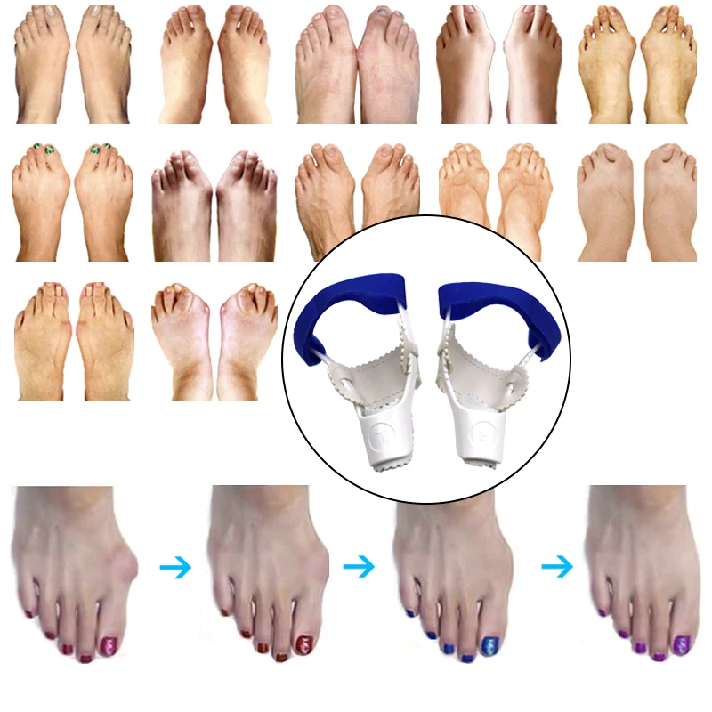 Bunion Device Hallux Valgus Orthopedic Braces Toe Correction Night Foot Care Corrector Thumb Goodnight Daily Big Bone Orthotics