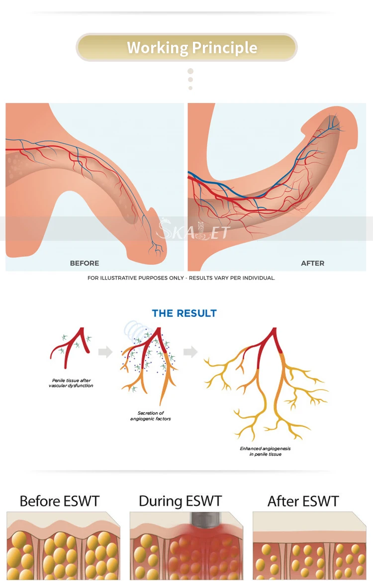 Самая безопасная eswt машина ударная волновая Терапия ed низкая интенсивность ударная волновая терапия для эрекции