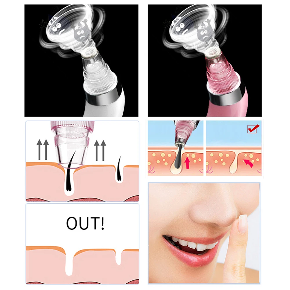 vacuum blackhead remover (6)