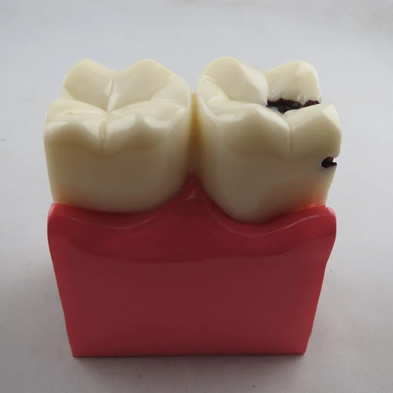Новый 1 шт. 6x протезов зубов Модель кариеса сравнение модели кариеса модель Стоматолог патологии для Медицинские товары преподавания