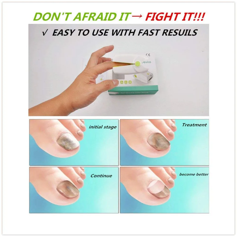 

Rechargeable Nail Fungus Laser Treatment Device Onychomycosis cure treat nail fungus and infections