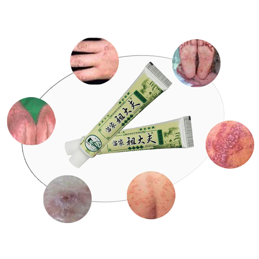 Chinese Herbal Medicine Creams Psoriasis Dermatitis and Eczema Pruritus