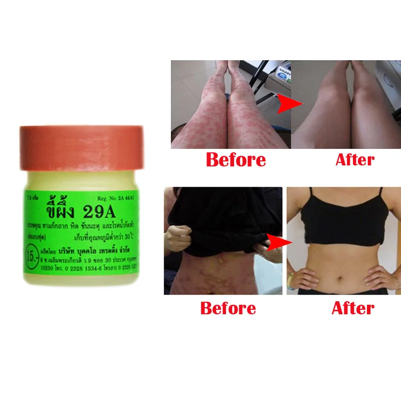 

2PCS Profesprofessional Cure Psoriasis Ointment Original From Vietnam Native Medicine Ingredient Security