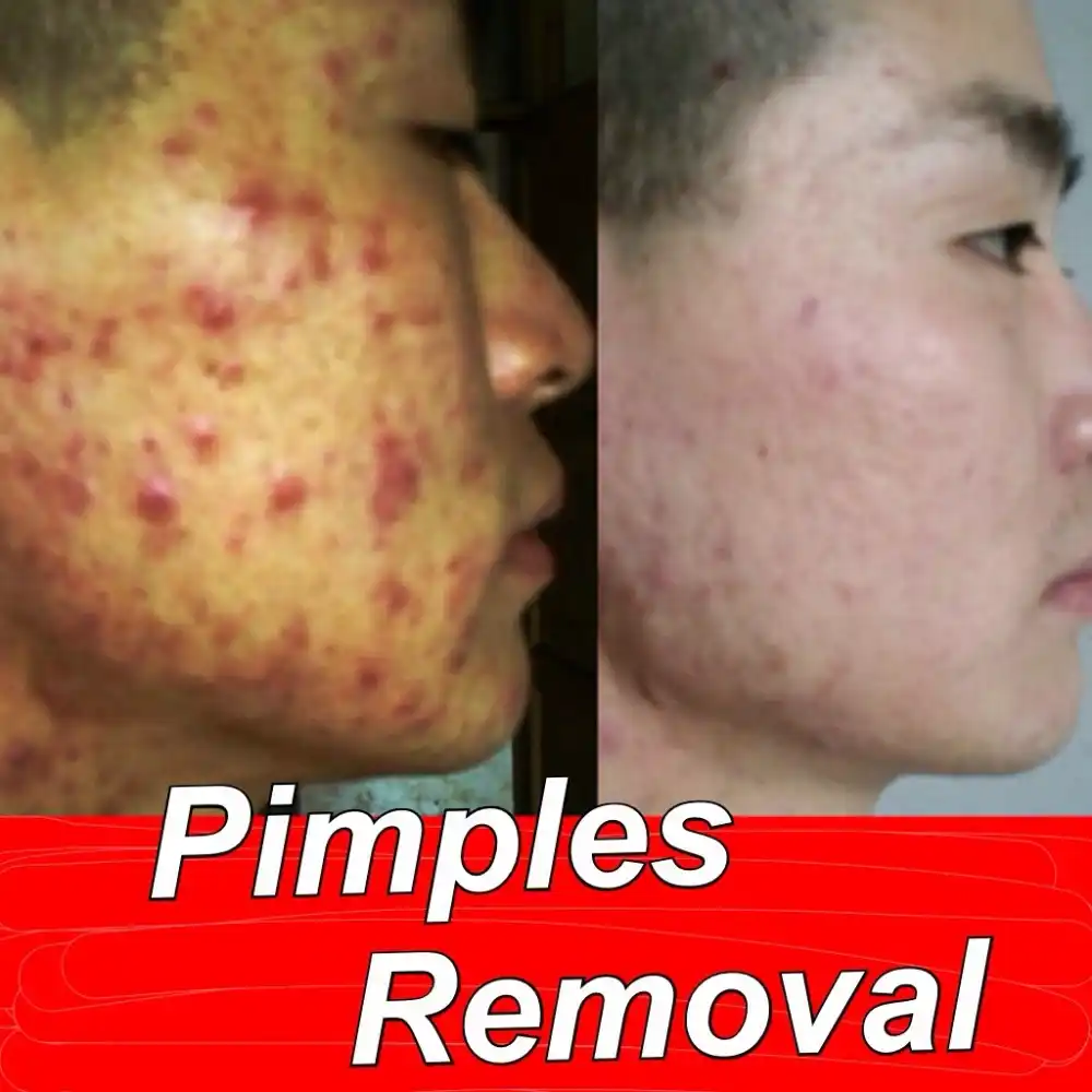 pimple and blackhead remover cream