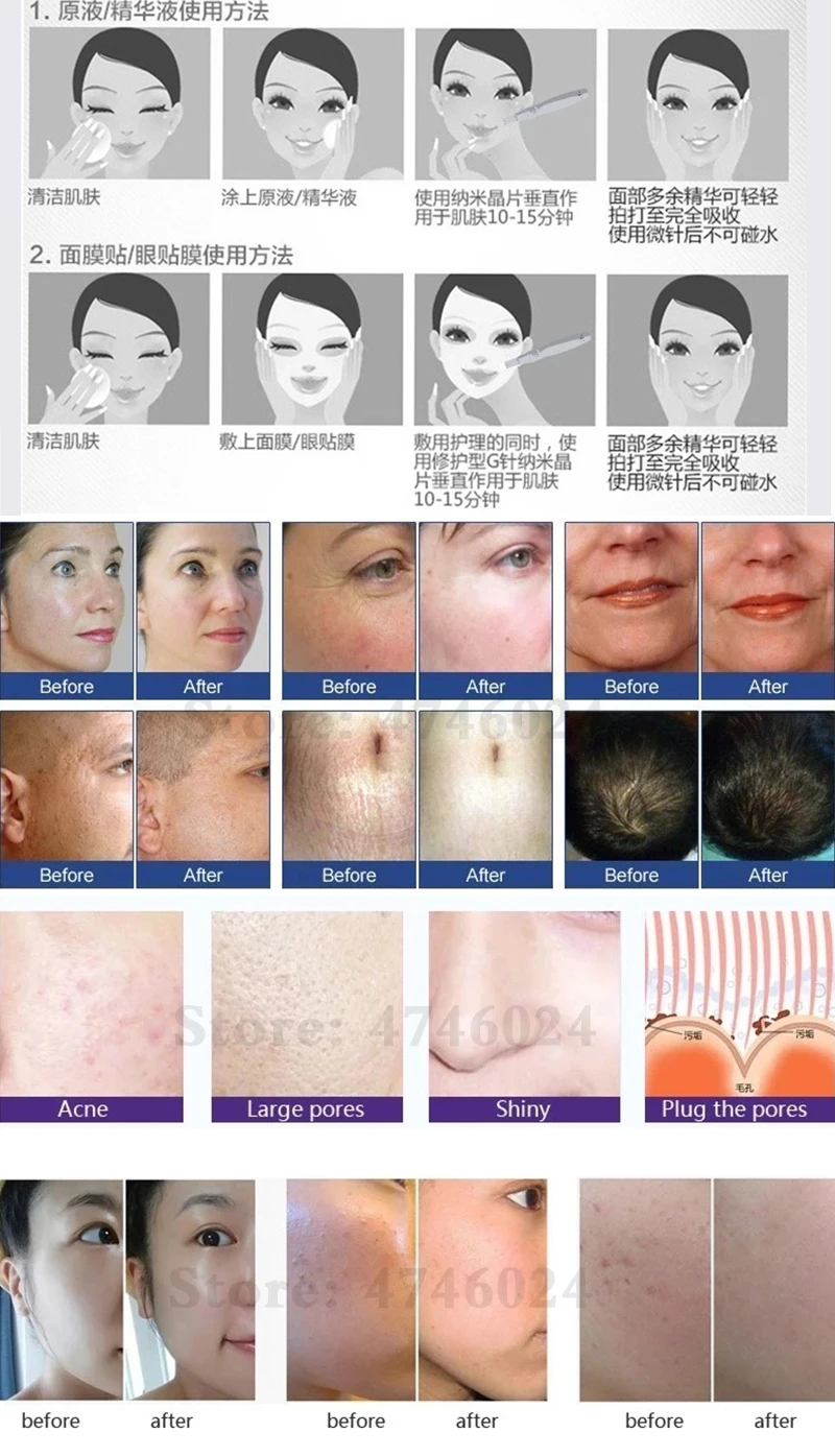 Branco de Meso Remove a Cicatriz da Acne Reduz o Brilho do Creme do bb do Estiramento Luz da Cor da Máquina 7 do Tratamento da Pena do Brilho do Creme do bb para o Soro de Brilho para Soro Brilho o de 5 Cremes BB e CC