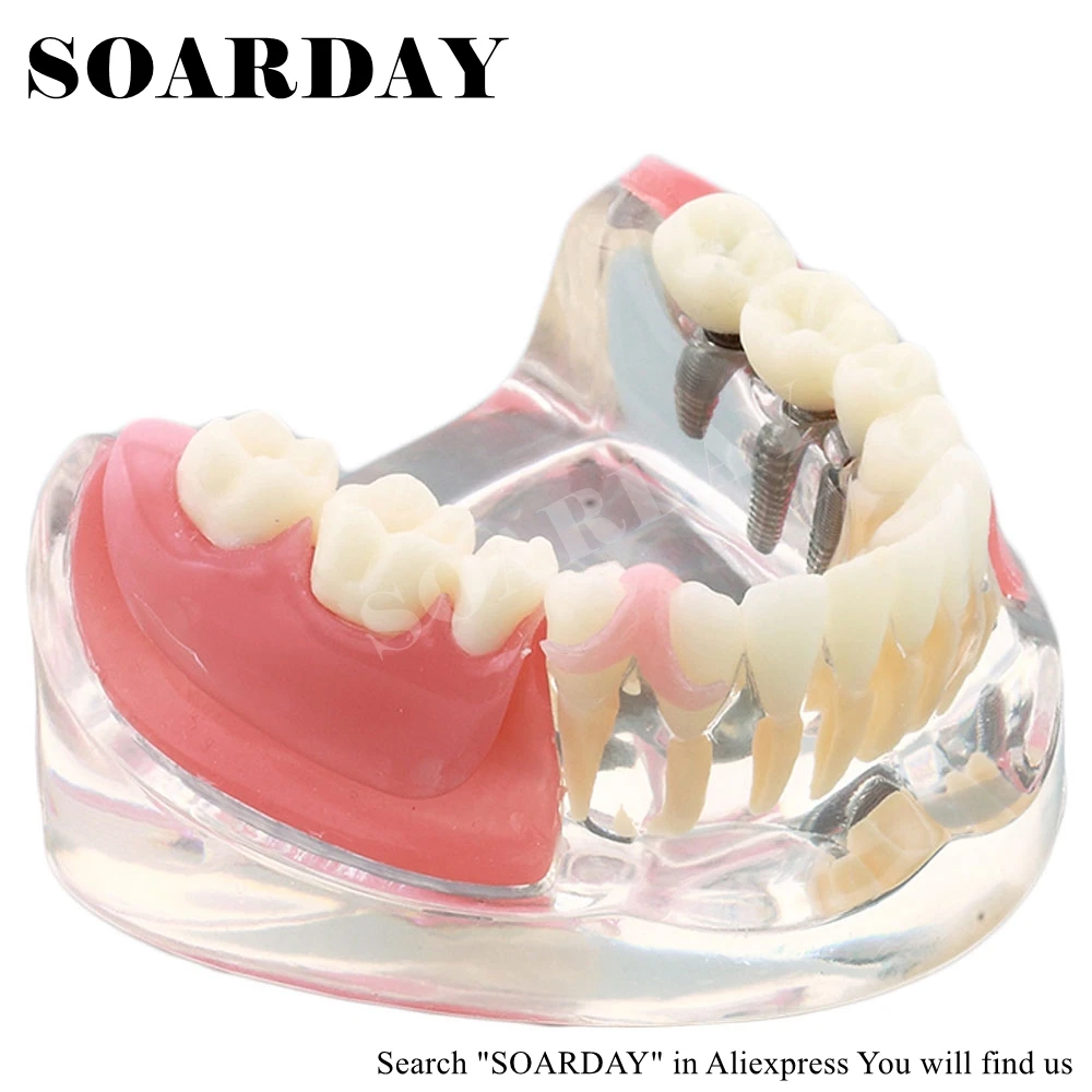 SOARDAY Implant & Restoration Model dental tooth teeth dentist dentistry anatomical anatomy model odontologia SOARDAY Implant & Restoration Model dental tooth teeth dentist dentistry anatomical anatomy model odontologia