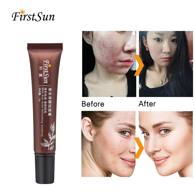 acne pigmentation removal cream