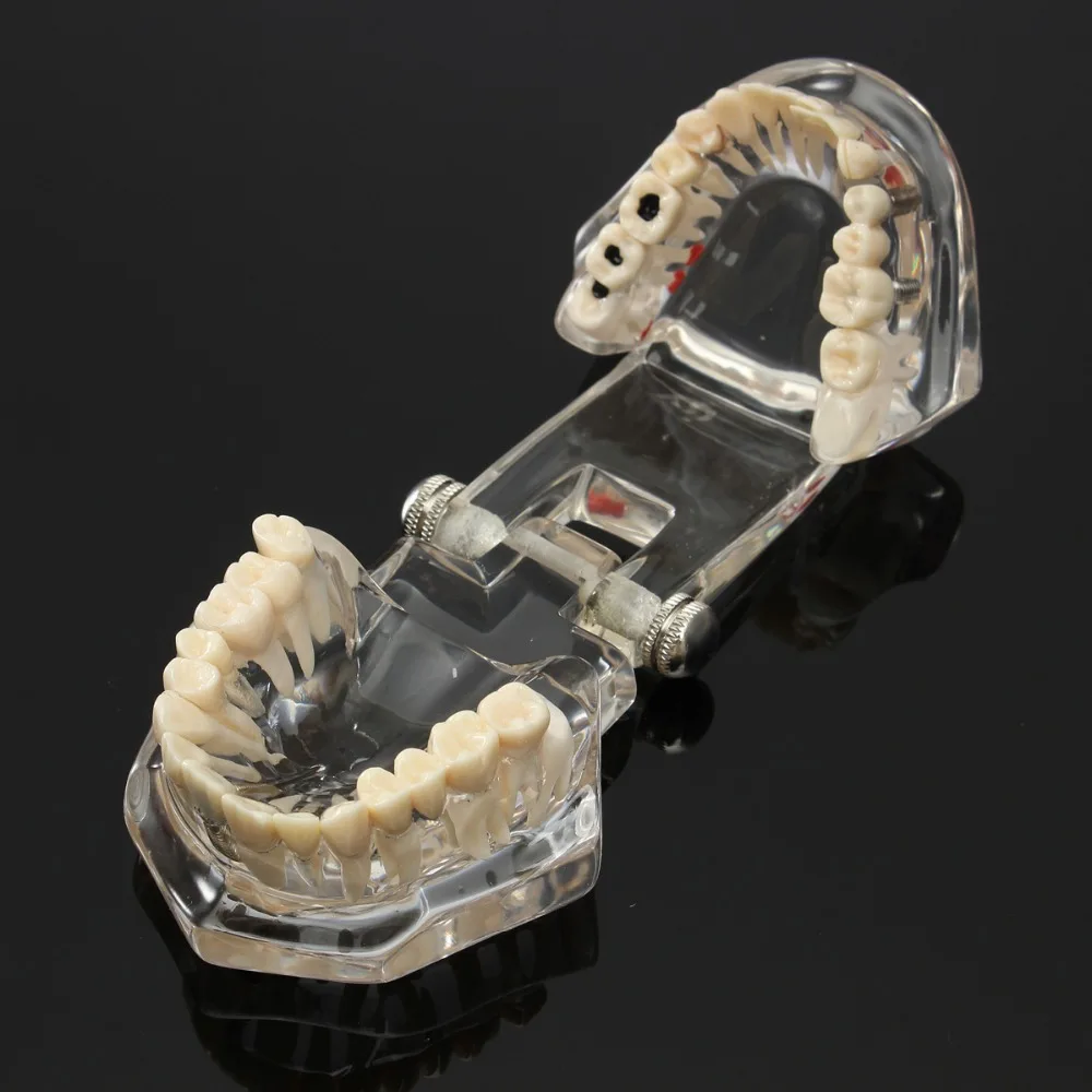 

Acrylic Dental Implant Disease Teeth Teach Model Restoration Bridge False Tooth Dentist Medical Science Lab Mold Tools Equipment