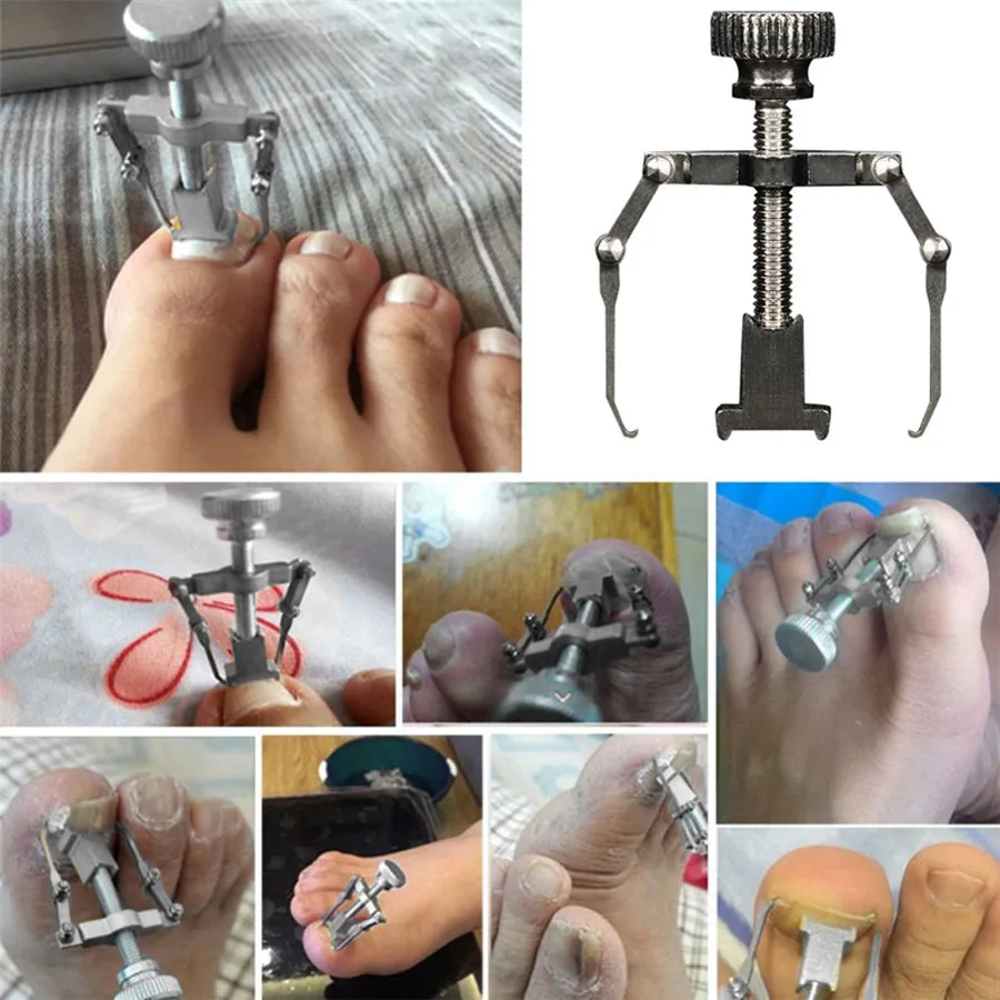 

Ingrown Toe Nail Recover Correction Tool Pedicure Toenail Fixer Foot Nail Care