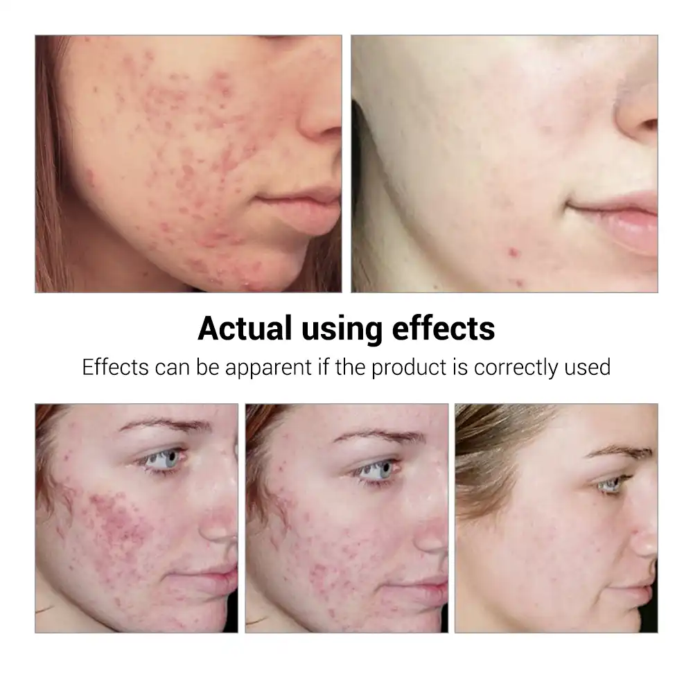 Crema para eliminar cicatrices de acne