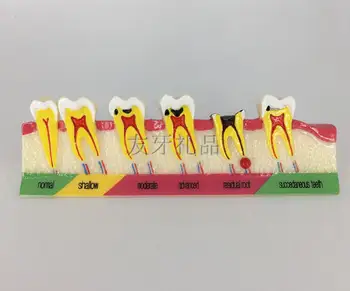 

Dental caries classification model dental teaching demonstration oral model