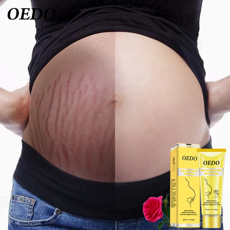 

Rose Remove Stretch Marks Cream Anti Wrinkle Anti Aging Maternity Skin Repair Remove Pregnancy Scars Treatment Body Skin Care