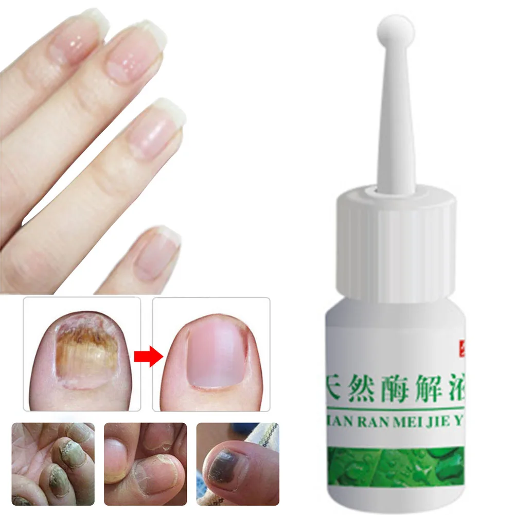 

Leuconychia Liquid Enzymolysis Liquid Convenient Onychomycosis Repair Ringworm Essential Oil Portable Painless Nail Removal