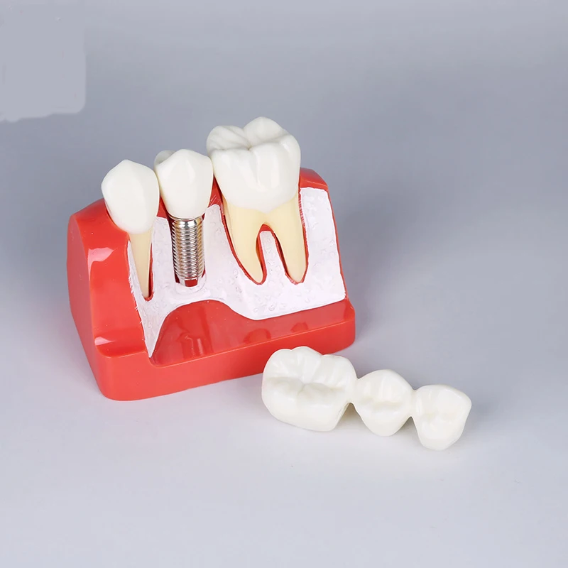 Стоматологическая модель образования/разъемная модель имплантата/мост Модель зубного имплантата/модель имплантата