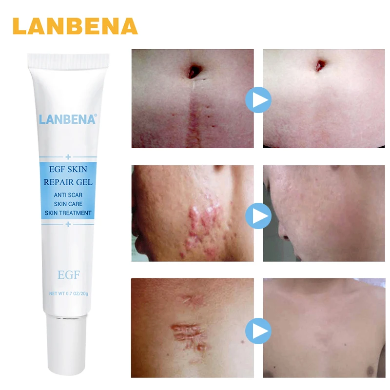 

LANBENA Face Cream Hyaluronic acid Anti Acne Acne Treatment Pigmentation Corrector Cream Removal Facial Blackhead Acne Skin Care
