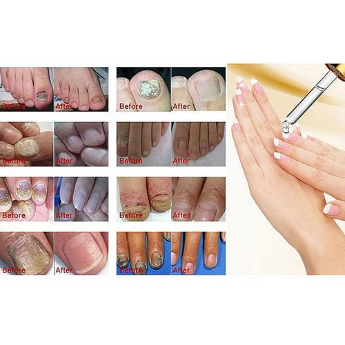 Восстанавливающий Гель лак для ногтей Новое поступление|onychomycosis treatment|fungus treatmentnail