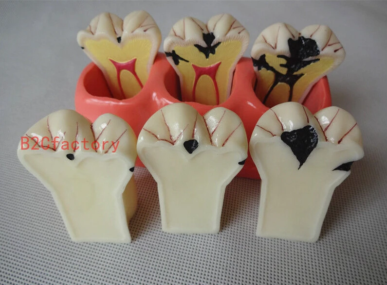 

1 Piece 4:1 Size Dental Caries Removable Teeth Tooth Model Learn Study Model