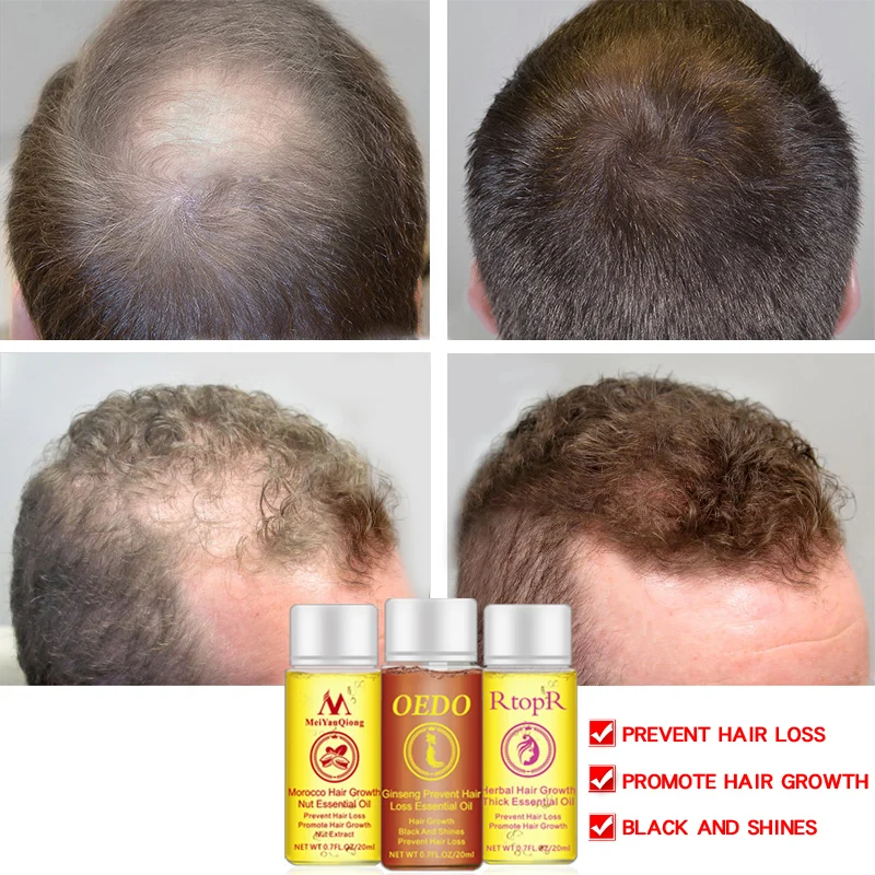 Густое длинное эфирное масло для роста волос эссенция против выпадения волос уход за волосами восстановление волос быстрее растет несмываемый кондиционер