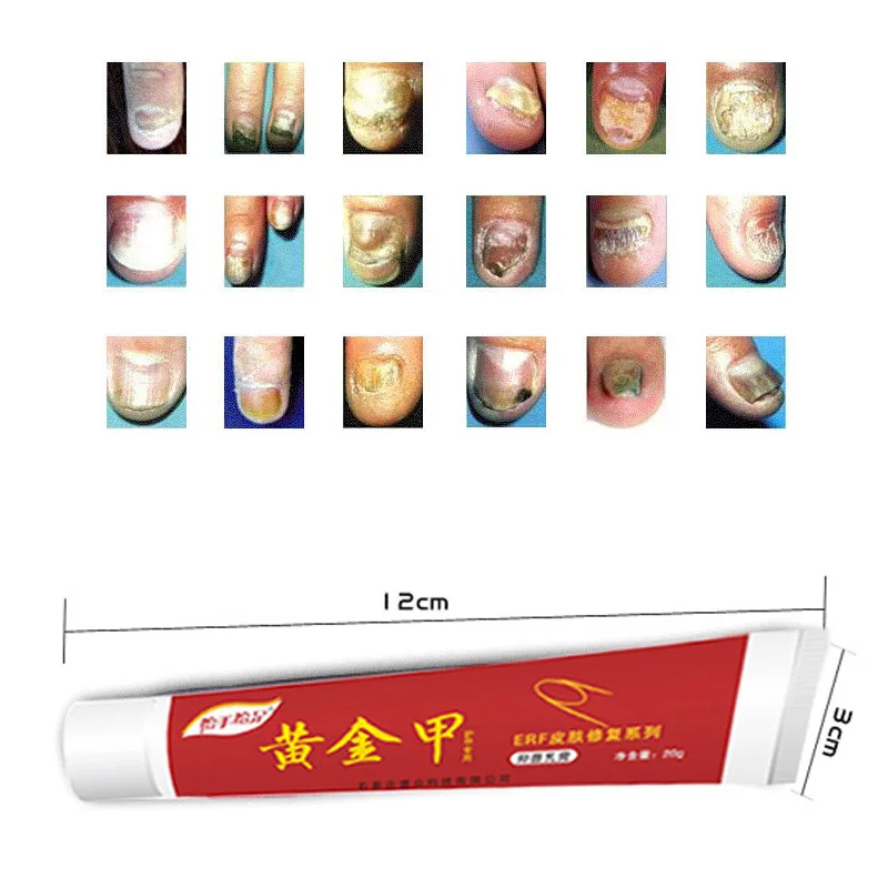 

Nail Fungus Treatment Onychomycosis Paronychia Anti Fungal Toenail Infection Repair Cream @ME88