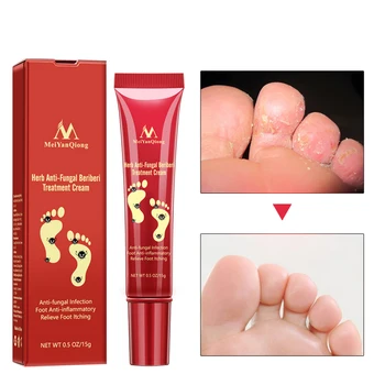 

Herbal Foot Treatment Anti Fungal Infection Onychomycosis Paronychia Effective Toe Fungus Treatment Feet Bottom Repair Cream
