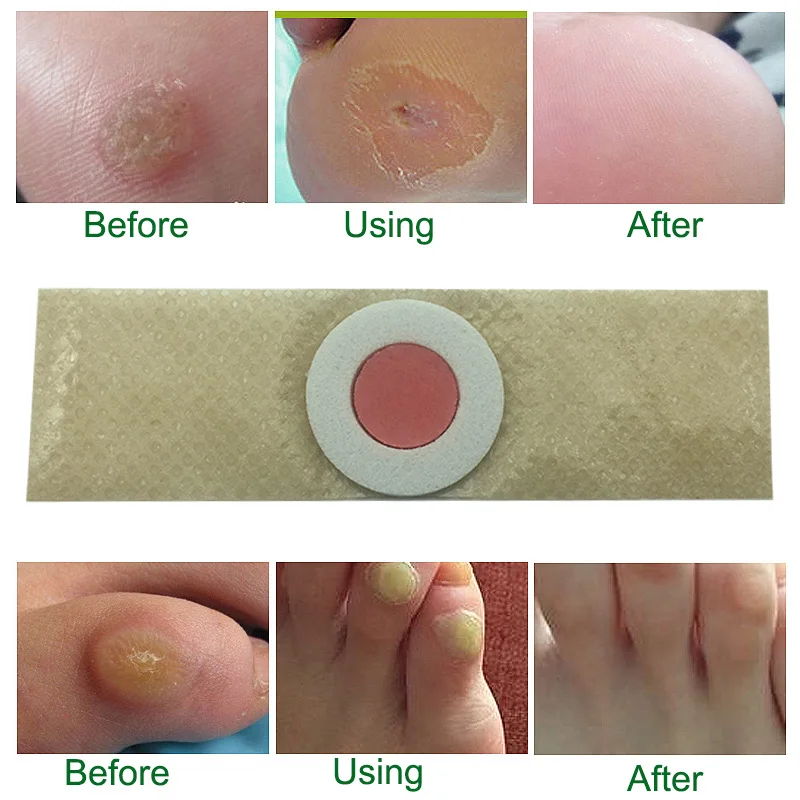 48 Pcs Foot Corn Removal Foot Care Medical Plaster Calluses Plantar Warts Thorn Plaster Health Care For Relieving Pain 48 Pcs Foot Corn Removal Foot Care Medical Plaster Calluses Plantar Warts Thorn Plaster Health Care For Relieving Pain