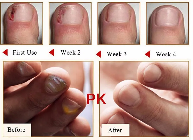 Травяное Лечение ногтей onychomicosis Paronychia против грибковой инфекции ногтей хороший результат Китайский Травяной Уход за ногтями