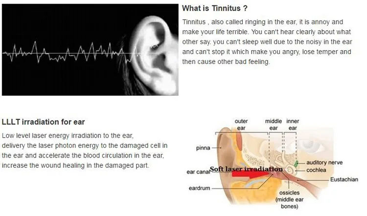 

Otitis media treatment cold soft laser noninvasive home use device