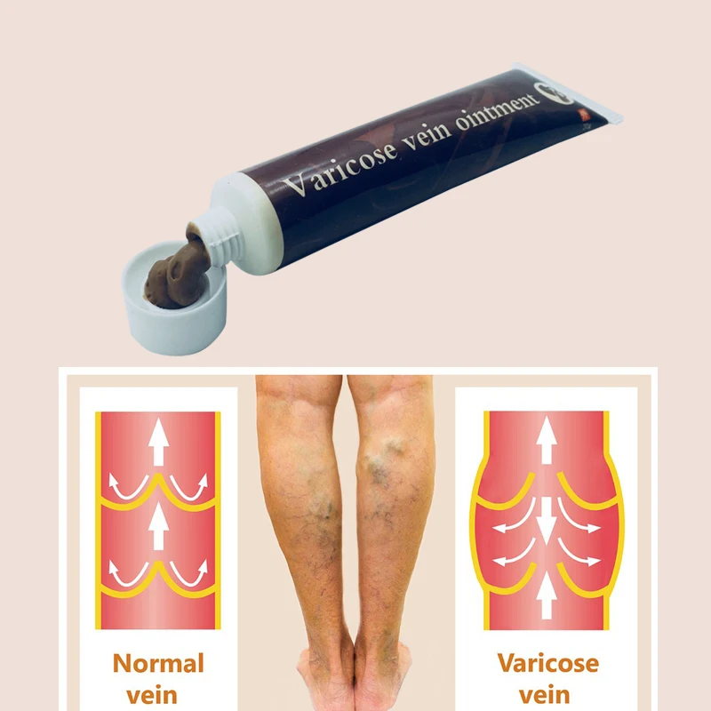 

Varicosity Varicose Veins Cream Treatment Anti Foot Leg Vasculitis Phlebitis Herbal Product Medical Plaster
